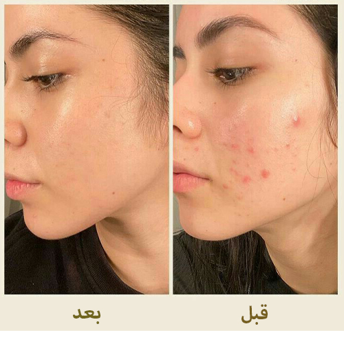 قبل و بعد از رعایت روتین پوست چرب و جوش دار