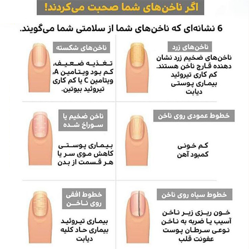 کاشت ناخن