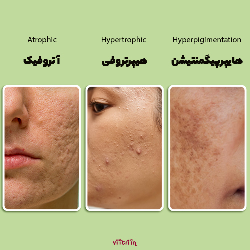 انواع جای جوش با روش خانگی